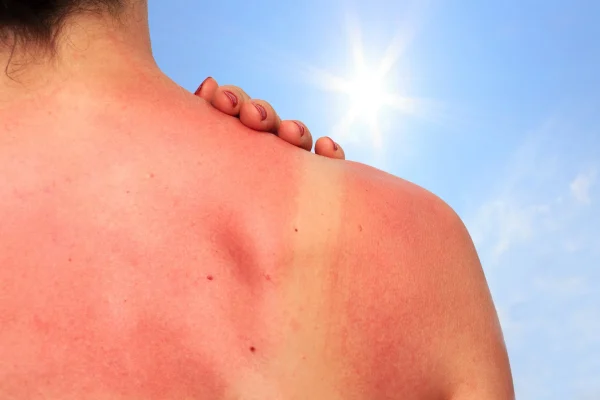 Severe sunburn on a person’s back showing the effects of sun exposure on skin under a bright summer sky