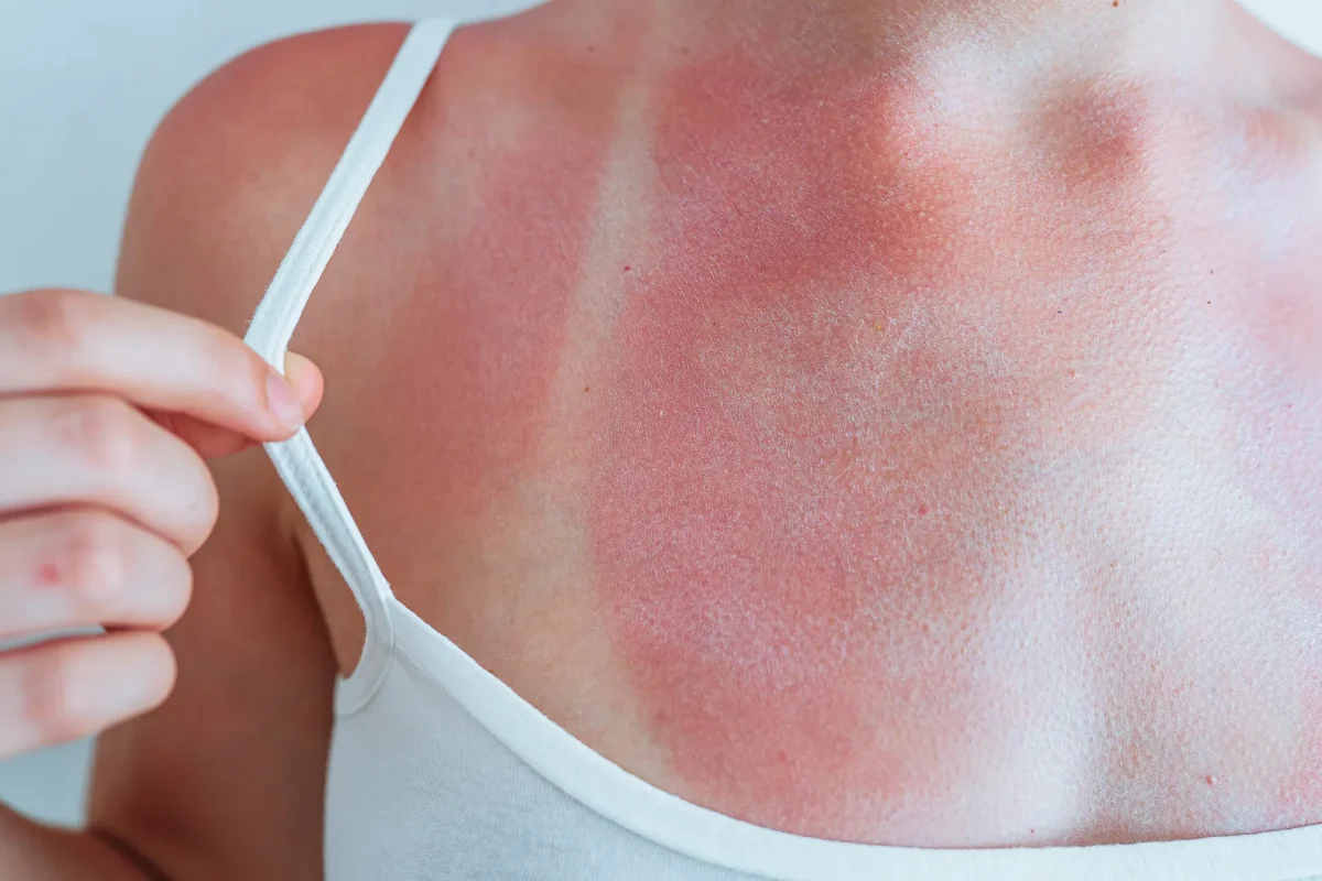 Close-up of a person with severe sunburn on the chest and shoulder. Visible red skin highlights the risks of UV radiation skin cancer.