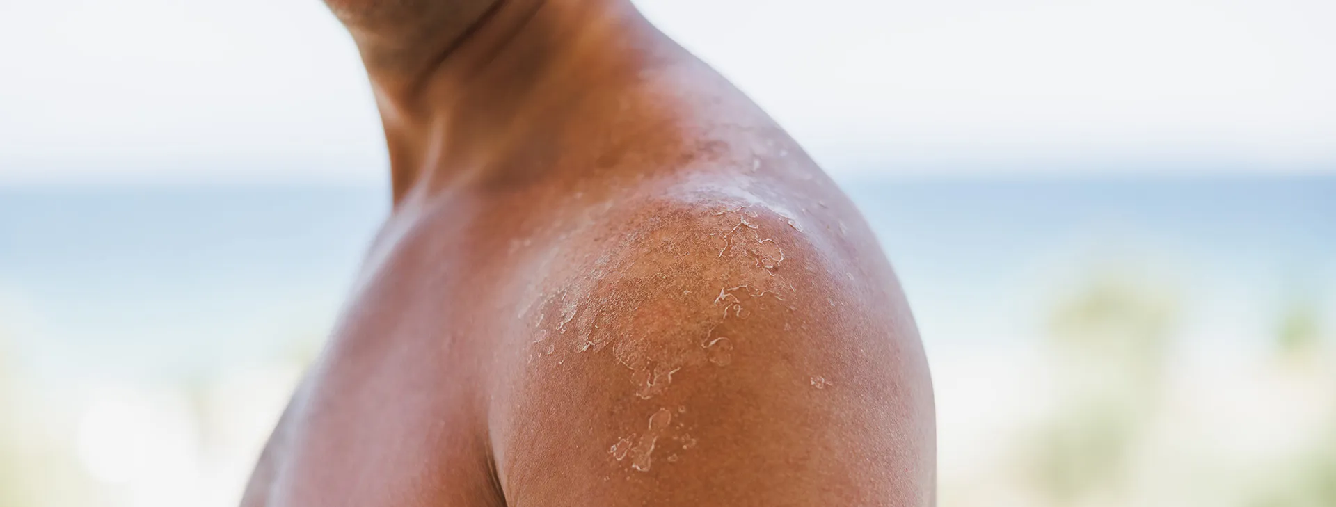 Shoulder with peeling skin after sunburn, illustrating the risks of UV radiation skin cancer.