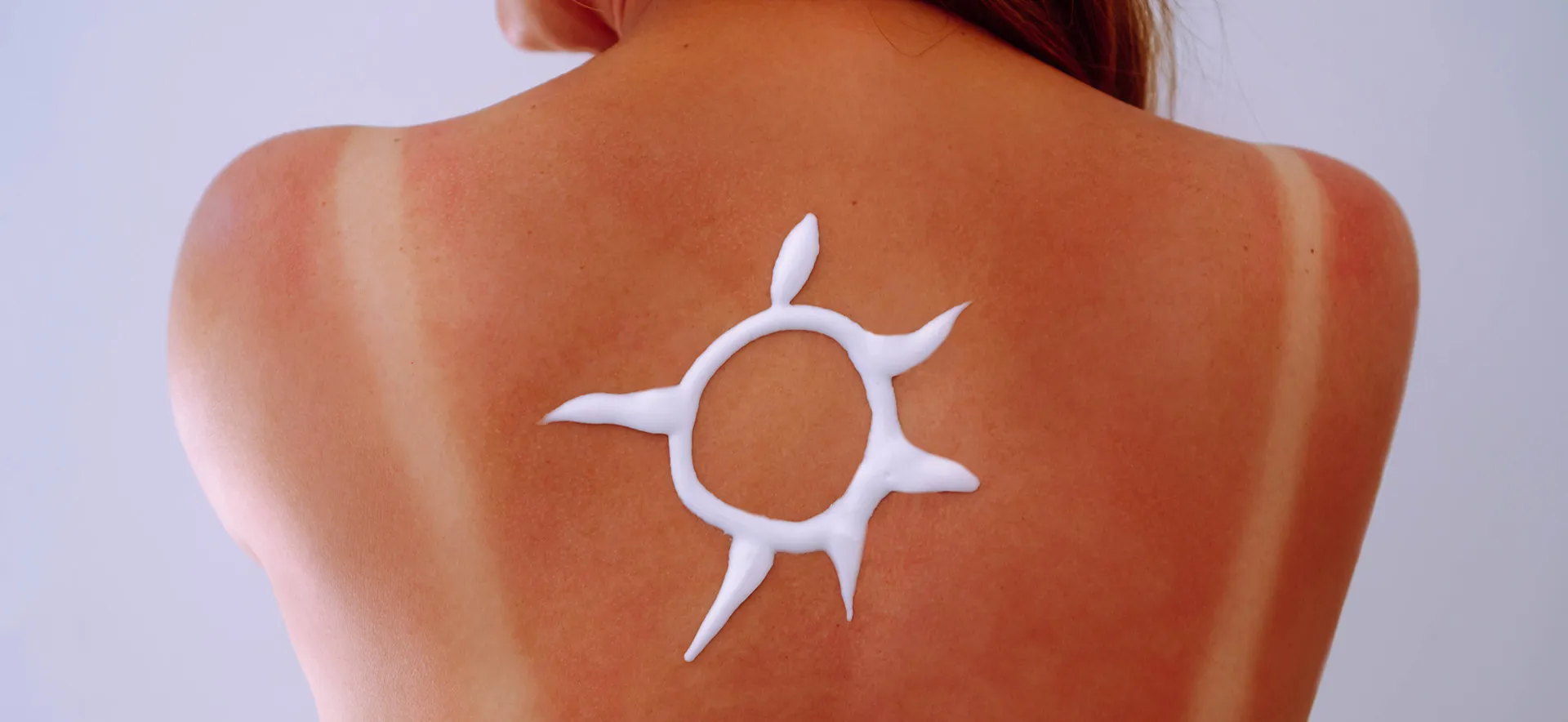 Back with visible tan lines and sun-shaped sunscreen design, illustrating what does SPF mean for skin protection.